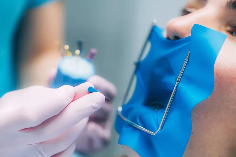 leczenie kanałowe koferdam Best Way Dent